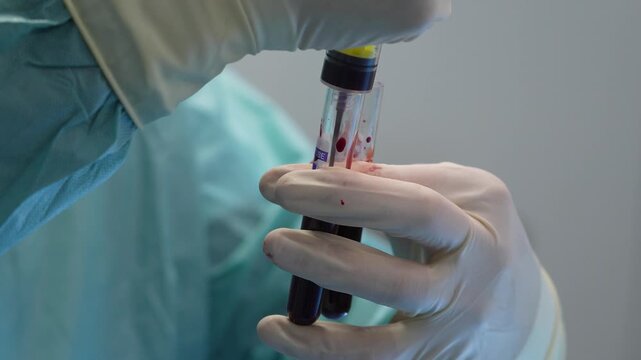 Surgeon's hands in sterile gloves carefully transferring human blood from one vial to another for medical analysis, research, or transfusion in a modern laboratory or operating room