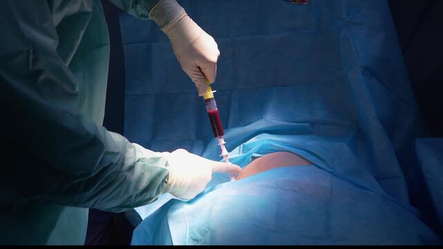 Medical professional in sterile gloves using a special needle and syringe to aspirate red bone marrow from a patient's iliac crest during a complex hematological procedure in a surgical theater