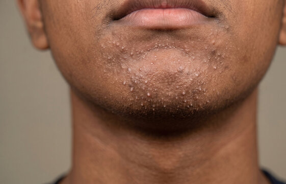 Close-up of a man's chin covered in numerous closed comedones, milia, and congested pores, showing textured skin.
