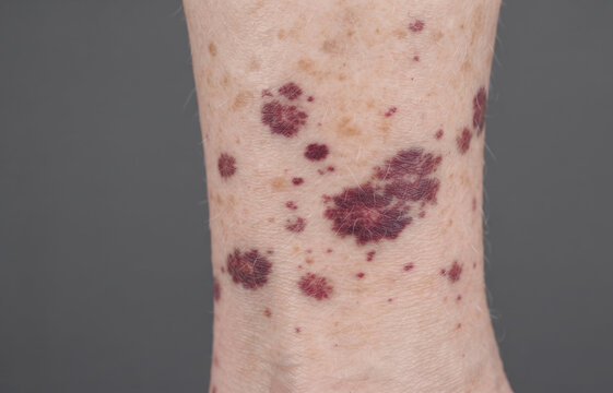 Close-up of a person's lower leg displaying dark purple patches, indicative of purpura, vasculitis, or a vascular skin disorder.