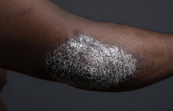 Extreme close-up of an elbow or knee on dark skin showing a thick, silvery, scaly plaque typical of severe psoriasis or hyperkeratosis.
