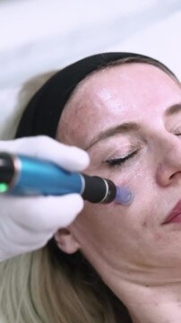 Vertical video. Face rejuvenation. Aesthetic beauty. Cosmetologist hand in gloves using microneedling tool for modern woman skin procedure.