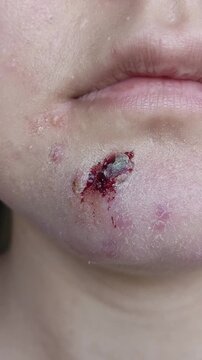 Close up of a bleeding sore on the chin caused by a squeezed pimple, representing acne consequences, skin damage, facial inflammation and problem skin.