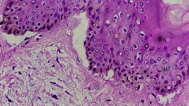 Fibroepithelial cyst in the groin area, also known as a fibroepithelial polyp (FEP), a common, benign, and usually harmless growth of skin and tissue.