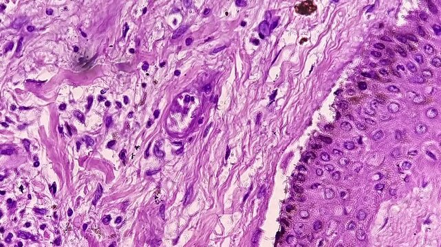 Fibroepithelial cyst in the groin area, also known as a fibroepithelial polyp (FEP), a common, benign, and usually harmless growth of skin and tissue.