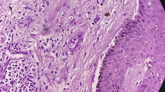 Fibroepithelial cyst in the groin area, also known as a fibroepithelial polyp (FEP), a common, benign, and usually harmless growth of skin and tissue.