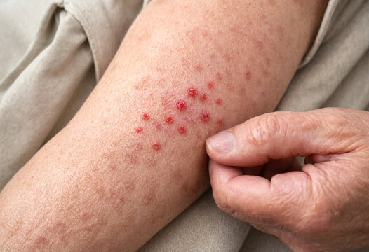 Person showing red itchy rash spots on inner arm skin