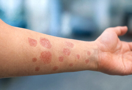 Person with red circular skin rash on forearm and hand