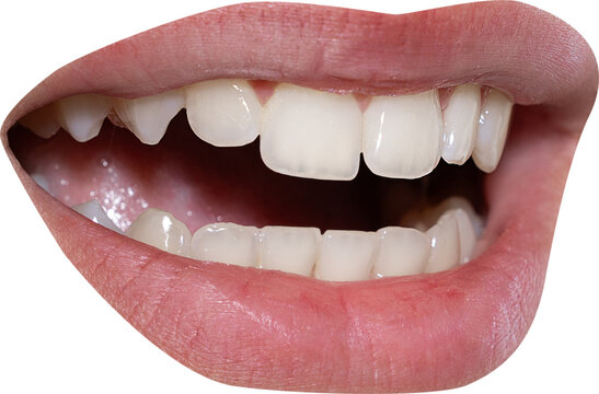 Angled adult mouth reveals irregular teeth in an expressive laugh isolated on transparent background. Oral health, authentic emotion and dental treatment concept.