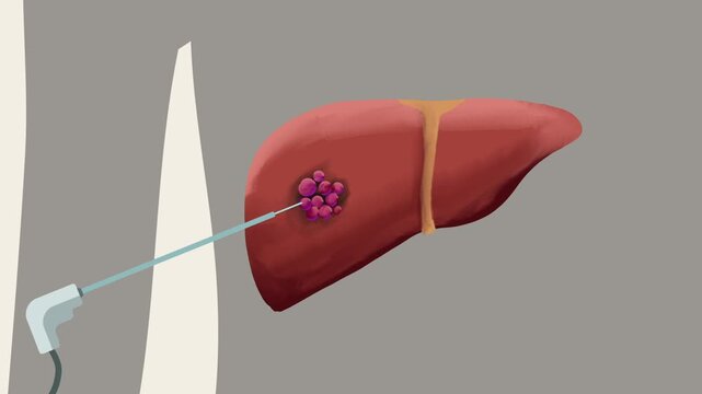 Animation of liver tumour being treated with thermal ablation