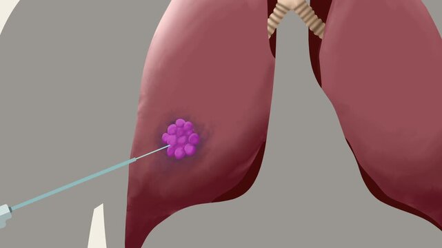 Animation of lung tumour being treated with thermal ablation