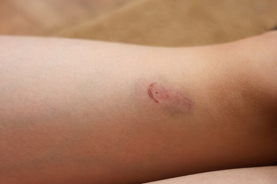 
Close-up of a small healing skin injury with redness, bruising and a dried scab on a human leg. Natural skin texture and minor wound visible in detail.