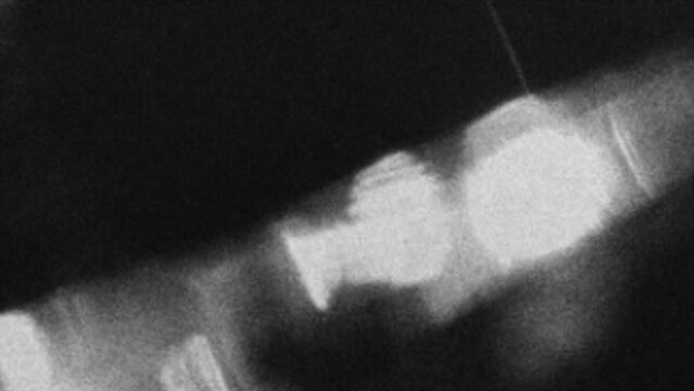 Medical x-ray image showing a dental tooth implant inside the human jaw bone