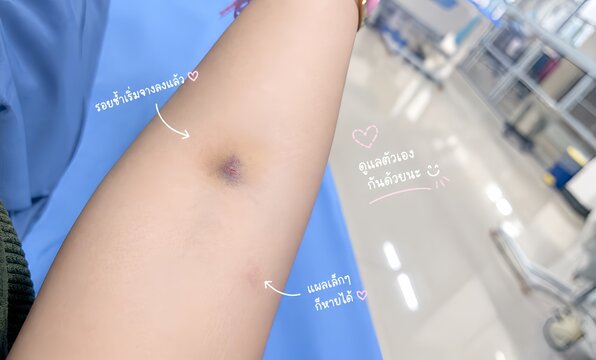Close up of arm with bruise and needle mark after blood donation or test in hospital background. Healing process, healthcare concept.