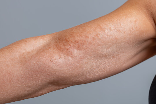 Sunlit forearm with uneven bumpy skin texture and light pigmentation, close up of aged arm surface with visible pores and fine hair