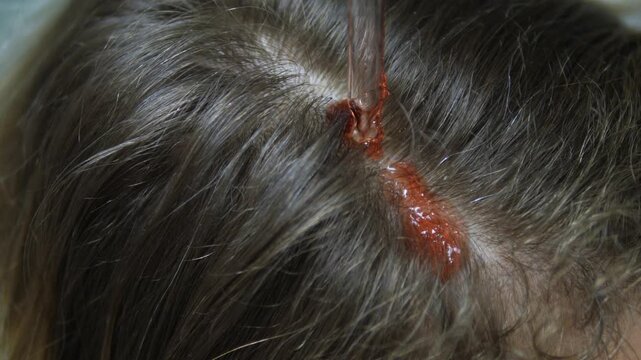 Scalp treatment receives liquid drops on parted hair. Clear applicator places reddish serum along hairline, suggesting careful cosmetic care with focused, clinical precision and calm attention.