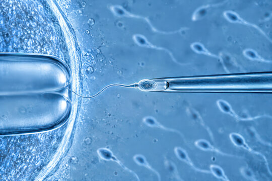 ICSI Fertilization Procedure with Sperm Injection into Egg Cell, IVF Medical Illustration