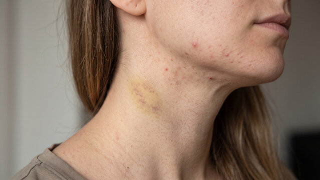 Woman displays a yellowish skin bruise and acne blemishes along her neck and jawline under soft lighting.
