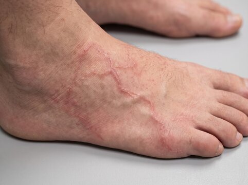 &ldquo;Cutaneous Larva Migrans of the Foot&rdquo;