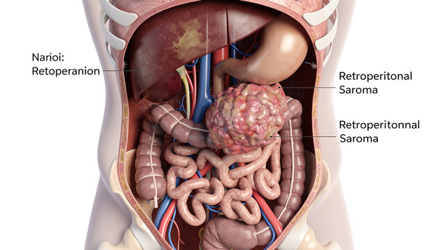 3D medical illustration of retroperitoneal saroma in human abdominal cavity, labeled anatomical diagram of retroperitoneal sarcoma tumor