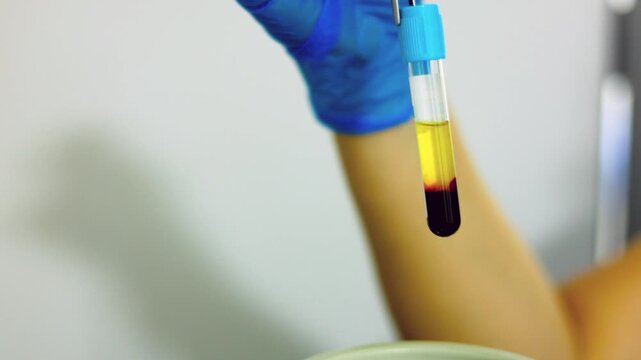 Platelet-Rich Plasma Sample for Regenerative Medicine Treatment