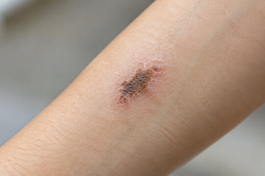 Healing scrape with scab on forearm, recovery and skin care concept