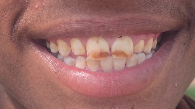Yellowed stained teeth with dental plaque and decay, close up of unhealthy human smile, damaged tooth enamel and oral hygiene issues