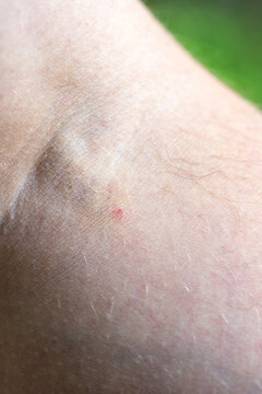 Close-up of a human arm showing a small red mark from a medical intravenous injection, skin texture and fine hair visible in natural light setting