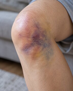 Close-up of a human knee with purple hematoma bruise and skin abrasion after a physical fall or sports injury