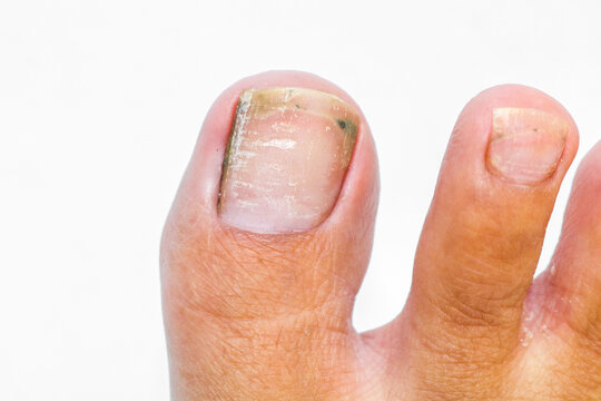 Closeup of an adult foot with long, untrimmed toenails and visible dirt beneath the nails, showing poor foot hygiene and neglected nail care isolated on white background. Ingrown toenails full of dirt