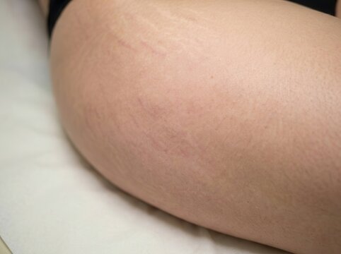 How to get rid of stretch marks