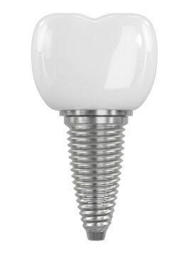 Dental implant model with silver metallic screw and white crown isolated on transparent background for oral surgery education.