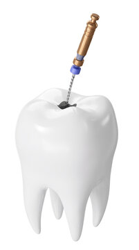 Human molar tooth model undergoing root canal treatment with endodontic file tool.
