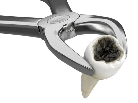 Extraction of a tooth with severe decay using forceps against a transparent background.