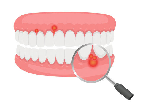 Gingivitis oral health illustration showing inflamed gums with magnifying glass for dental disease awareness and prevention.