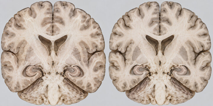 Coronal Brain Sections Comparing Subtle Hippocampal Atrophy