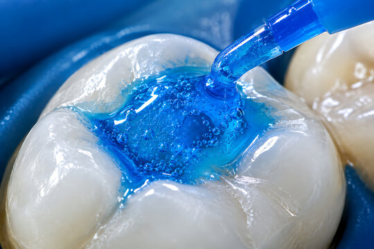 Blue Dental Composite Resin Gel Applied to Tooth for Cavity Restoration, Enamel Protection and Preventive Dentistry Vector Illustration