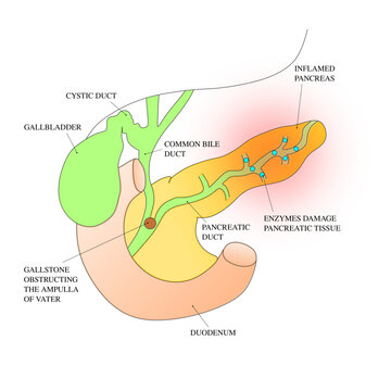 Acute Pancreatitis