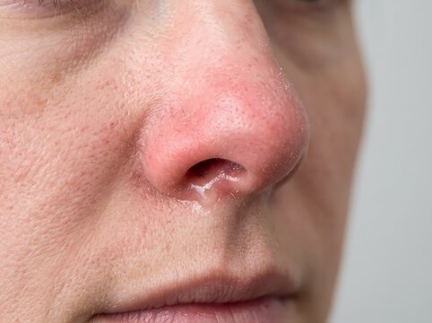 Close-up of a human nose showing redness and nasal discharge due to a cold, flu, or viral infection