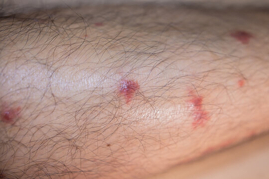 Close-up of multiple red insect bite marks caused by biting midges, sand flies, showing localized skin irritation and inflammation.
