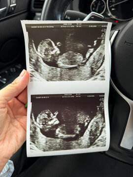 A woman holds two ultrasound scan prints in a car. ugc