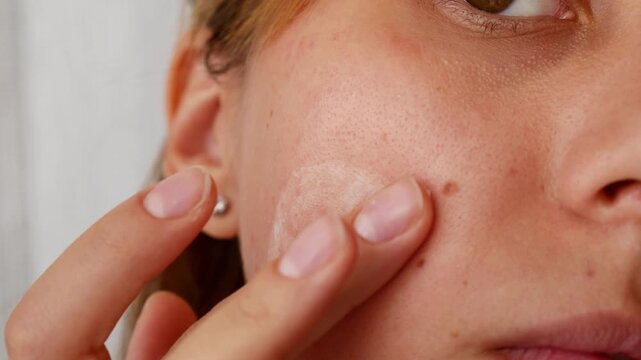 Woman applying soothing cream to irritated facial skin, skincare for redness and sensitivity