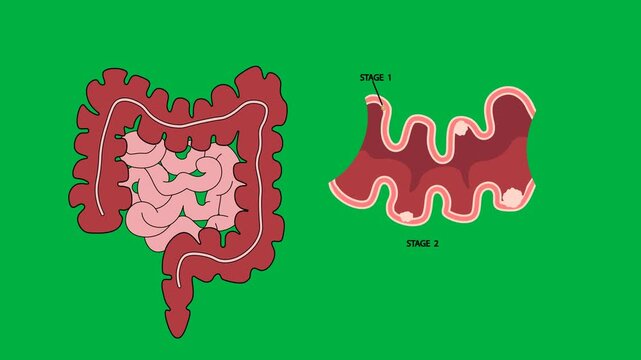 Medical vector illustration showcasing diagram of the human lower digestive system and a close-up cross-section of the colon wall. It provides a detailed comparison of the distinct stages of bowel 