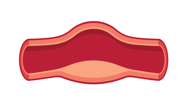 Fusiform aneurysm arterial bulge spindle-shaped dilation flat vector illustration for vascular surgery and pathology education