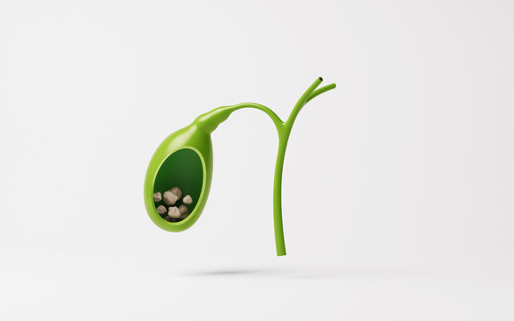 Medical 3D illustration of gallbladder stone, 3d rendering.