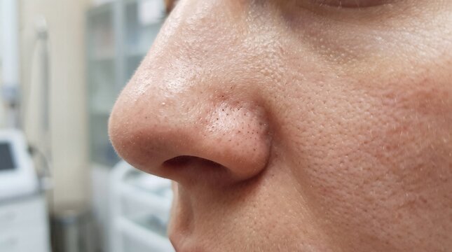 Dermatological macro skin texture and pore analysis: extreme macro close-up of adult male nose bridge and cheek epidermis revealing pores and hair follicles. Detailed clinical photography image.
