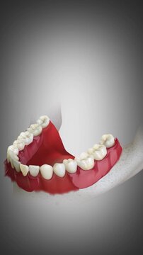 3D animation of removable partial denture for the lower jaw.	