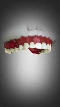 3D animation of removable partial denture for the upper jaw.	