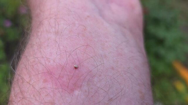 The bee left a sting with a vial of poison in the mans skin. The bubble contracts and delivers poison through the sting into the body of the animal that attacked the bee.