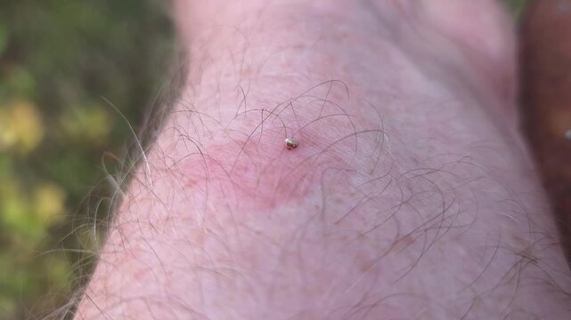 The bee left a sting with a vial of poison in the mans skin. The bubble contracts and delivers poison through the sting into the body of the animal that attacked the bee.